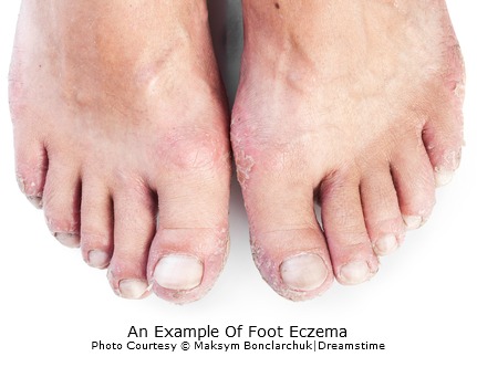 Eczema | Dermatitis | Atopic Dermatitis | MedlinePlus