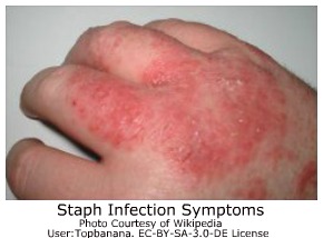eczema staph infection