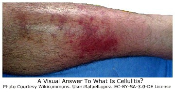 Is cellulitis contagious?