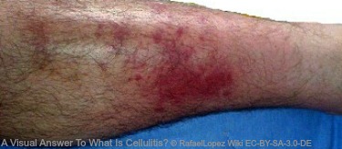 What Is Cellulitis