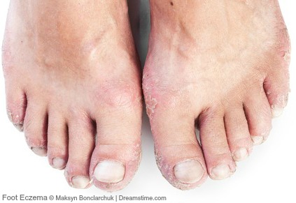 Foot eczema Foot eczema