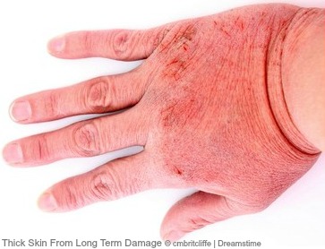 skin thick eczema protein producing found does